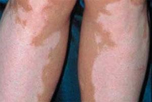 女性腿部白斑扩散有哪些办法可以防止