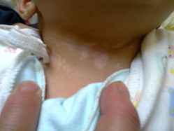 婴幼儿早期白癜风是什么症状