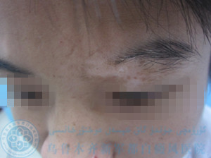 刘某/男性/局限型/眼部白斑